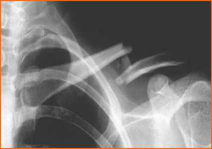 如果你有【鎖骨骨折】(Clavicle fracture)點算好很難醫治嗎中元堂跌打骨傷科幫到你